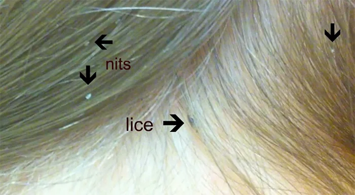 How to Identify Head Lice - Lice Clinics of America - Hawaii
